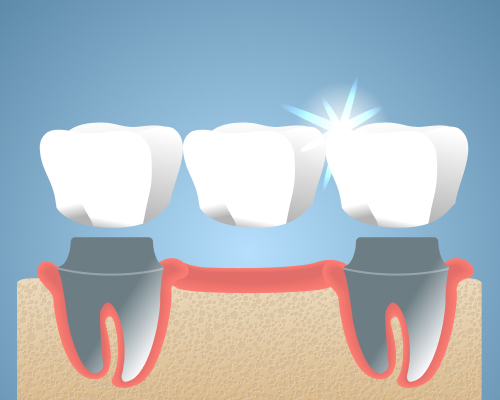 smiley-dental-beverly-crown-mobile