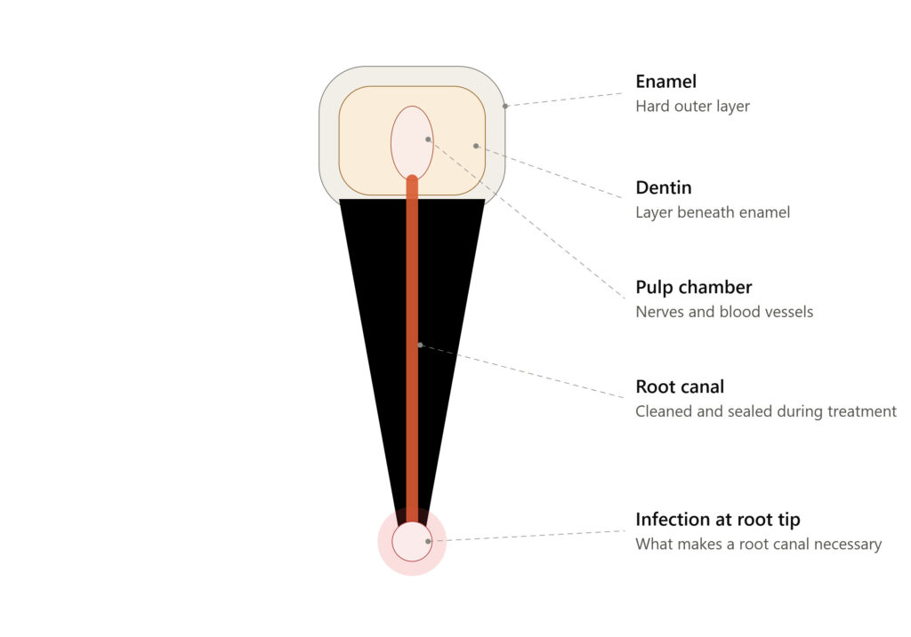 Diagram of a tooth cross-section showing the enamel, dentin, pulp chamber, root canal, and infected root tip treated by root canal therapy