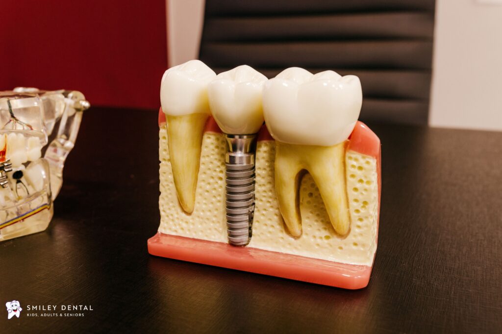 Dental implant model illustrating how an implant post and crown replace a missing tooth in seniors
