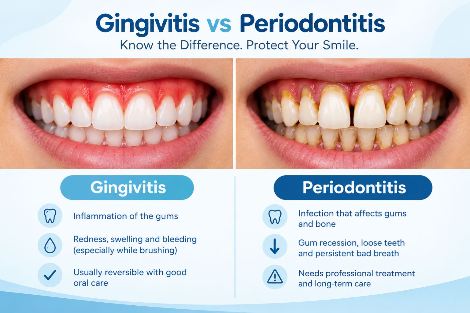 Gingivitis vs periodontitis comparison showing healthy pink gums next to red, swollen, and receding gums with plaque buildup